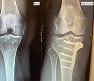 The word osteotomy is intimidating for both patients and some surgeons.