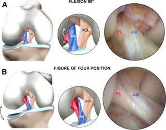 ACL Preservation (ACL Repair) Surgery