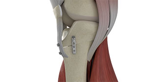 Anterior Tibial Osteotomy