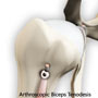 Arthroscopic Biceps Tenodesis