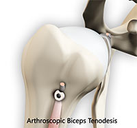 Arthroscopic Biceps Tenodesis