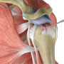 Arthroscopic Rotator Cuff Repair