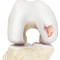 Chondral (Articular Cartilage Defects)