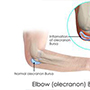 Elbow Bursitis