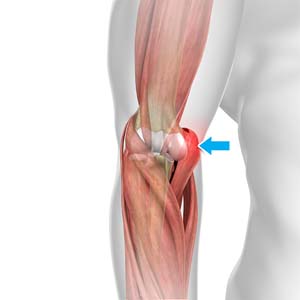 Golfer’s Elbow