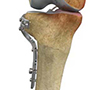 High Tibial Osteotomy