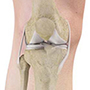 MISHA Knee Implant System