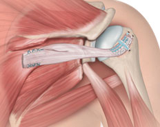 Lower Trapezius Transfer