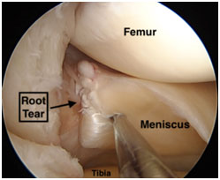 Meniscal Root Repair