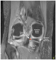 Meniscal Root Repair