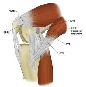 Medial Quadriceps Tendon Femoral Ligament (MQTFL) Reconstruction
