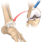 OATs – Osteochondral Autograft Transplant