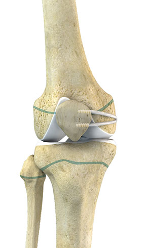 Pediatric MPFL Reconstruction