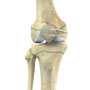 Pediatric MPFL Reconstruction
