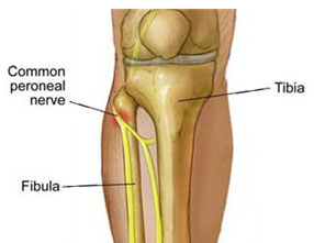 Peroneal Nerve Entrapment Release