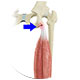 Proximal Hamstring Repair