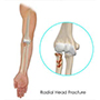 Radial Head Fracture