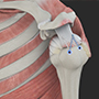Revision Rotator Cuff Repair