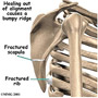 Snapping Scapula Syndrome