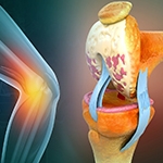 Cartilage Restoration in Seattle, Bellevue, Everett & Kirkland: Common Causes of Cartilage...