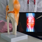 What Is Cartilage Restoration? A Guide for Patients in Seattle, Bellevue, Everett & Kirkla...