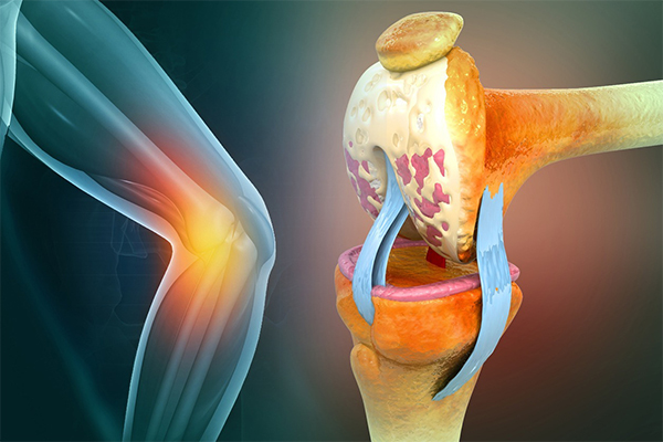Cartilage Restoration in Seattle, Bellevue, Everett & Kirkland: Common Causes of Cartilage Damage Explained