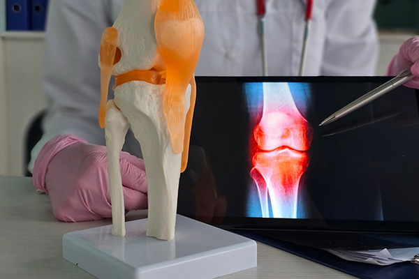 What Is Cartilage Restoration? A Guide for Patients in Seattle, Bellevue, Everett & Kirkland, WA
