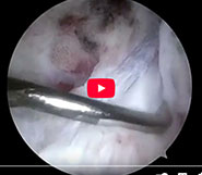 2nd look after ACL Repair