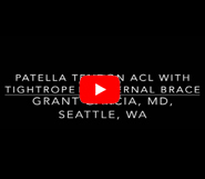 ACL Patella Tendon Reconstruction with Tightrope and Internal Brace.