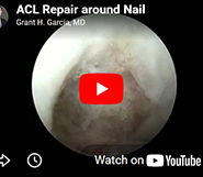 Dr. Garcia demonstrates an ACL repair around a tibial nail