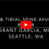 Dr. Garcia’s newest technique to fix ACL tibial spine using the new
ACL tightrope system 