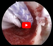 All Soft Button Tightrope - Quad ACL Reconstruction First in Washington State