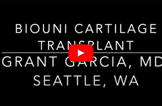 Dr. Garcia’s technique for a larger cartilage transplant called a
BioUni. This is a great option to save patients knee’s and reduce
arthritis.