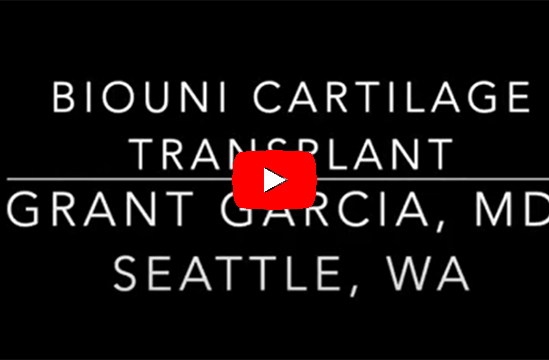 Dr. Garcia’s technique for a larger cartilage transplant called a
BioUni. This is a great option to save patients knee’s and reduce
arthritis.