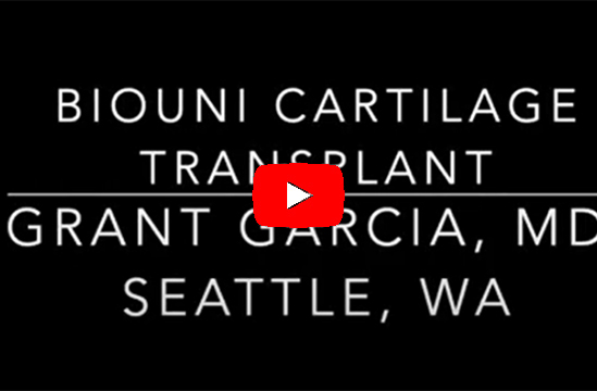 Dr. Garcia’s technique for a larger cartilage transplant called a
BioUni. This is a great option to save patients knee’s and reduce
arthritis.