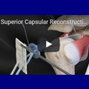 Capsular Reconstruction