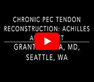 Chronic Pec Tear Reconstruction with Achilles Allograft