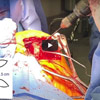  Dr. Garcia demonstrates his cutting edge technique for subscapularis
repair after stemless total shoulder replacement.