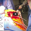  Dr. Garcia demonstrates his cutting edge technique for subscapularis
repair after stemless total shoulder replacement.