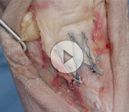 Dr.Garcia demonstrates his distal patella tendon repair technique