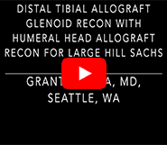 Distal Tibial Allograft with Humeral Head Allograft