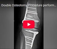 Double Osteotomy Procedure performed by Dr. Garcia