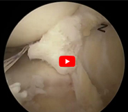 Dr. Garcia’s - Anterior Meniscal Root Repair Technique