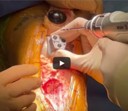 Dr. Garcia demonstrates a custom patellofemoral replacement
