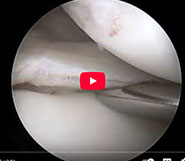 Dr. Garcia’s Hay Barrel Technique for Discoid Meniscus Repair