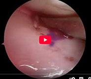 Dr. Garcia’s updated technique for ACL with medialmeniscus transplant surgery