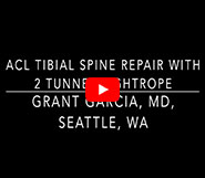 Dr. Garcia’s New Tensionable Tibial Spine Technique