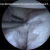 Dr. Garcia demonstrates his advanced technique for arthroscopic
glenoid fracture fixation as well as bony bankart repair. This technique
improves healing time and reduces stiffness over the open approach.