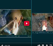 Full MACI, TTO, MPFL with Rods and Cones Video Technology