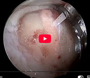 Largest MACI Arthro performed in the US